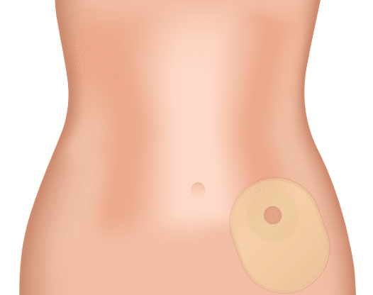 ostomy example