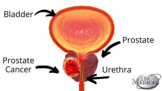 bladder prostate urethra prostate cancer